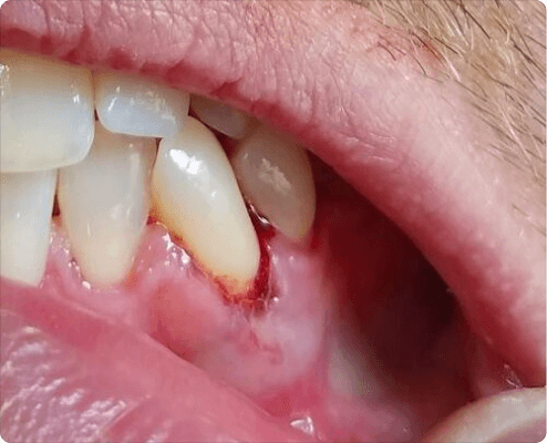 Advanced Gum Disease