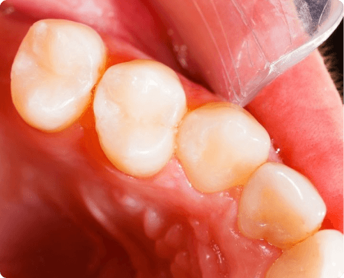 Dental Fillings image