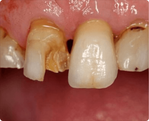 Dental Implants Info