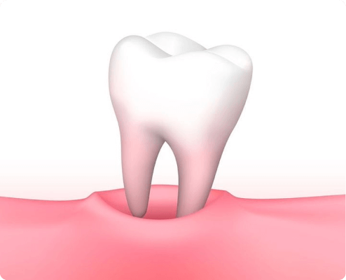 Tooth Extractions Image