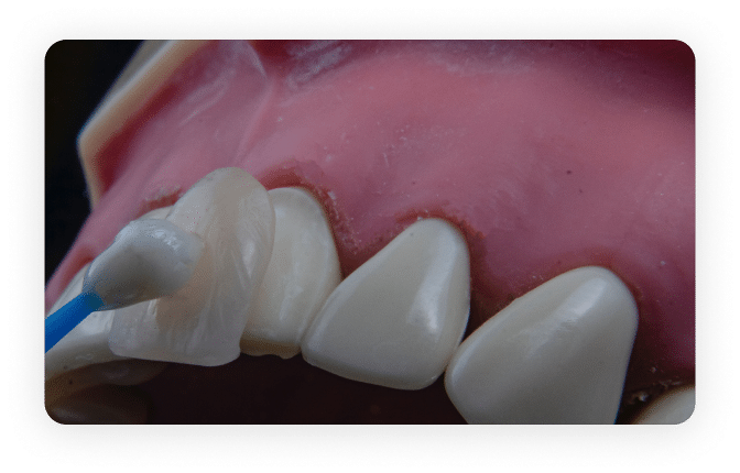 Close-up view of dental capping procedure on teeth.