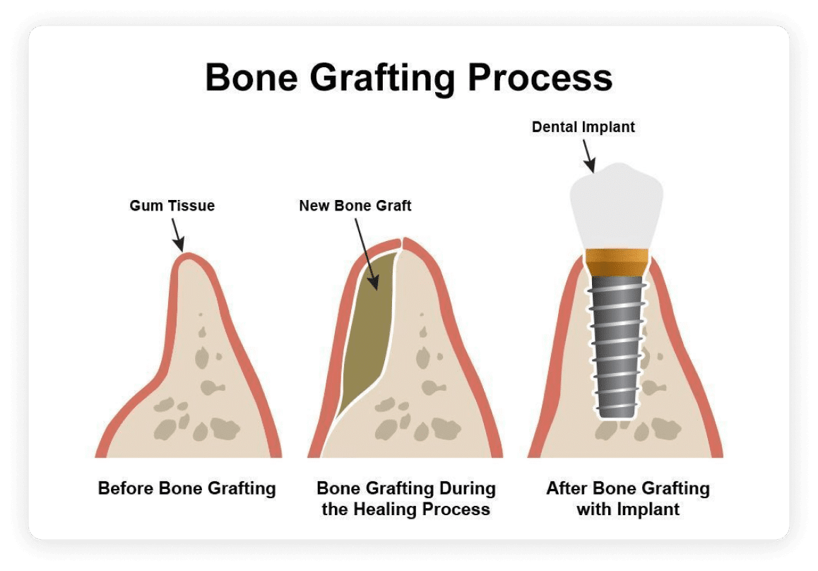Bone grafting process