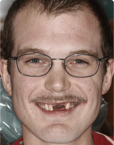 A man with broken teeth