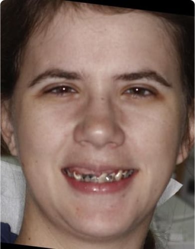 Before and after images showcasing teeth whitening results.
