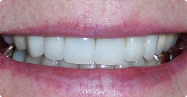 white teeth of a man