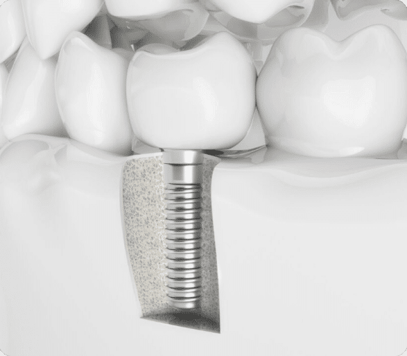 teeth showing with screw