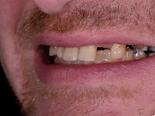 tooth has broken of a man