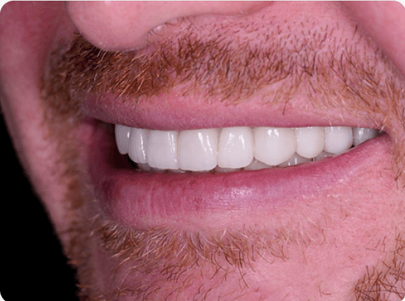 A man smiling with clean teeth