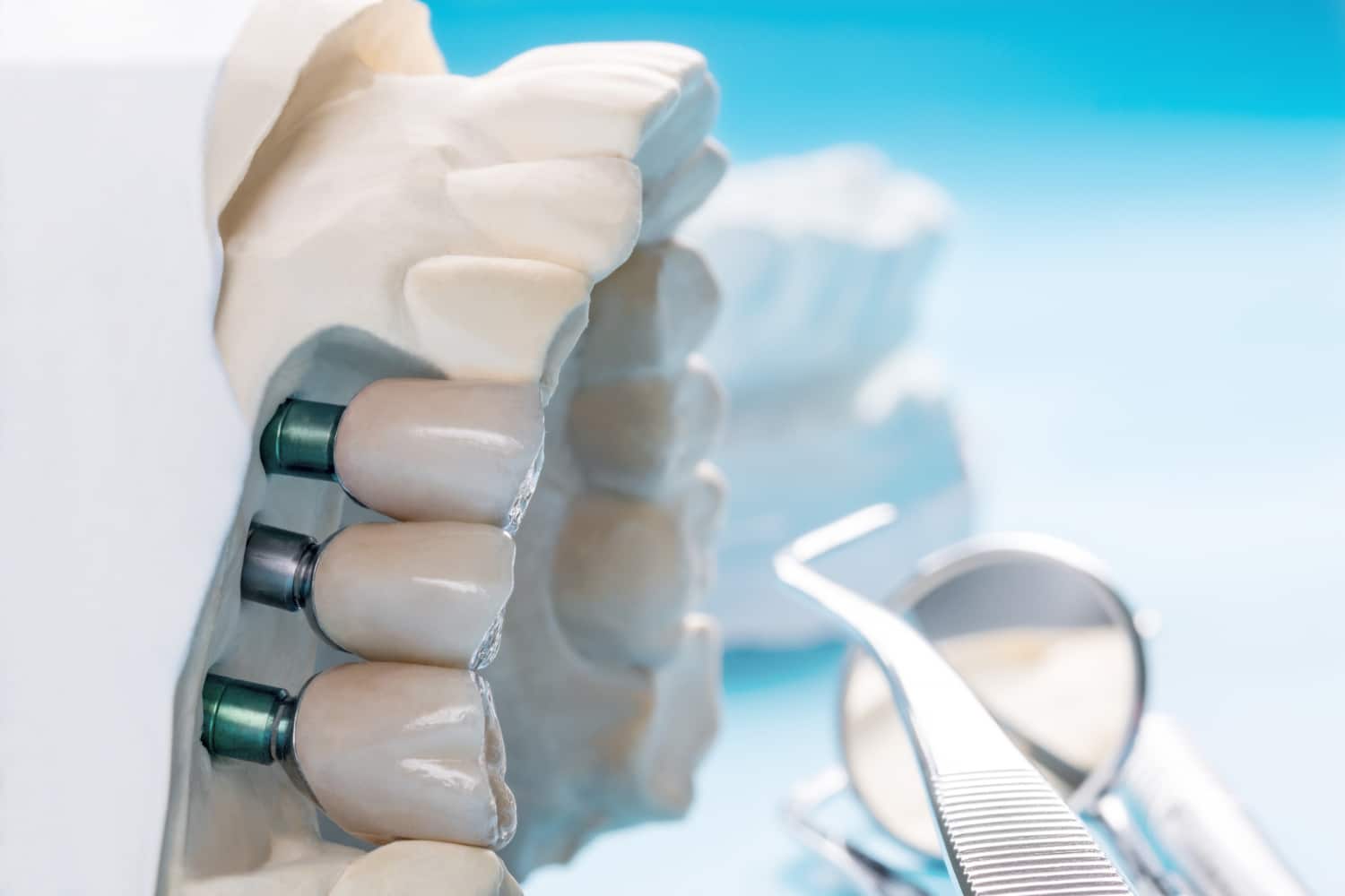 What If My Dental Insurance Doesn’t Cover Dental Implants?