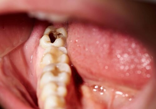 severe tooth decay in Bridgewater, VA