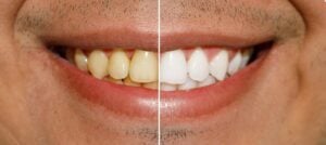 before and after of a teeth whitening treatment from Smiles for Life Dental Care