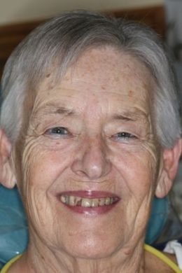 large_image_1559153416 Patient before receiving all on 4 dental implants.